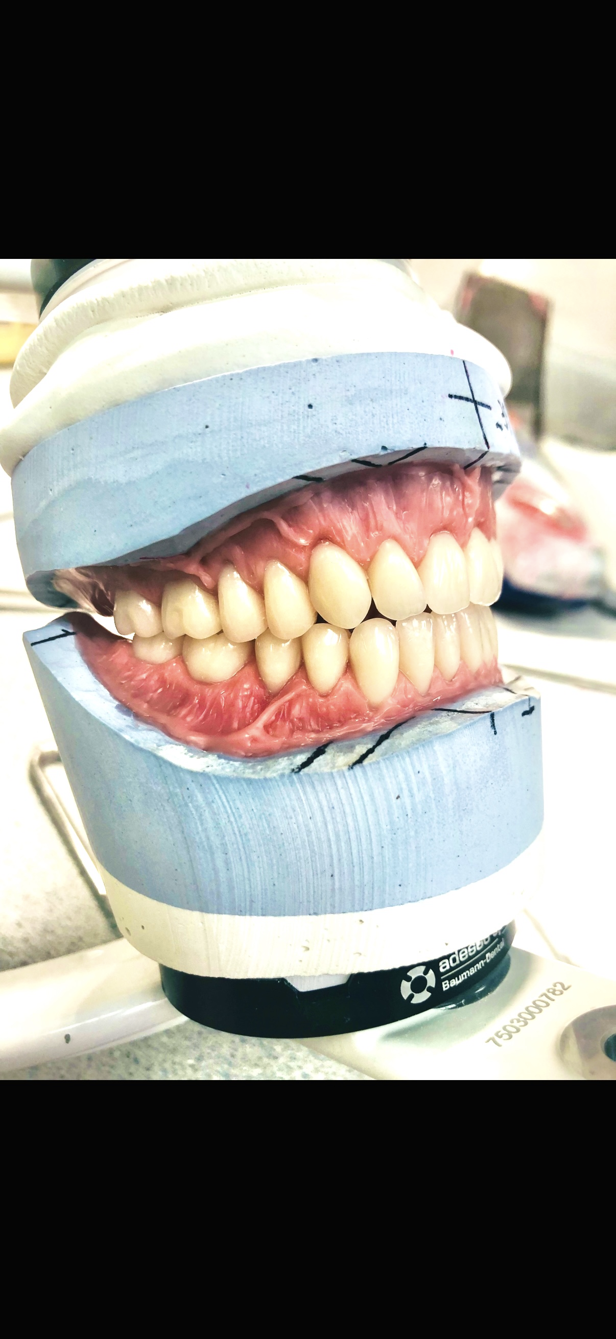BPS Dentures (Biofunctional Prosthetic System)