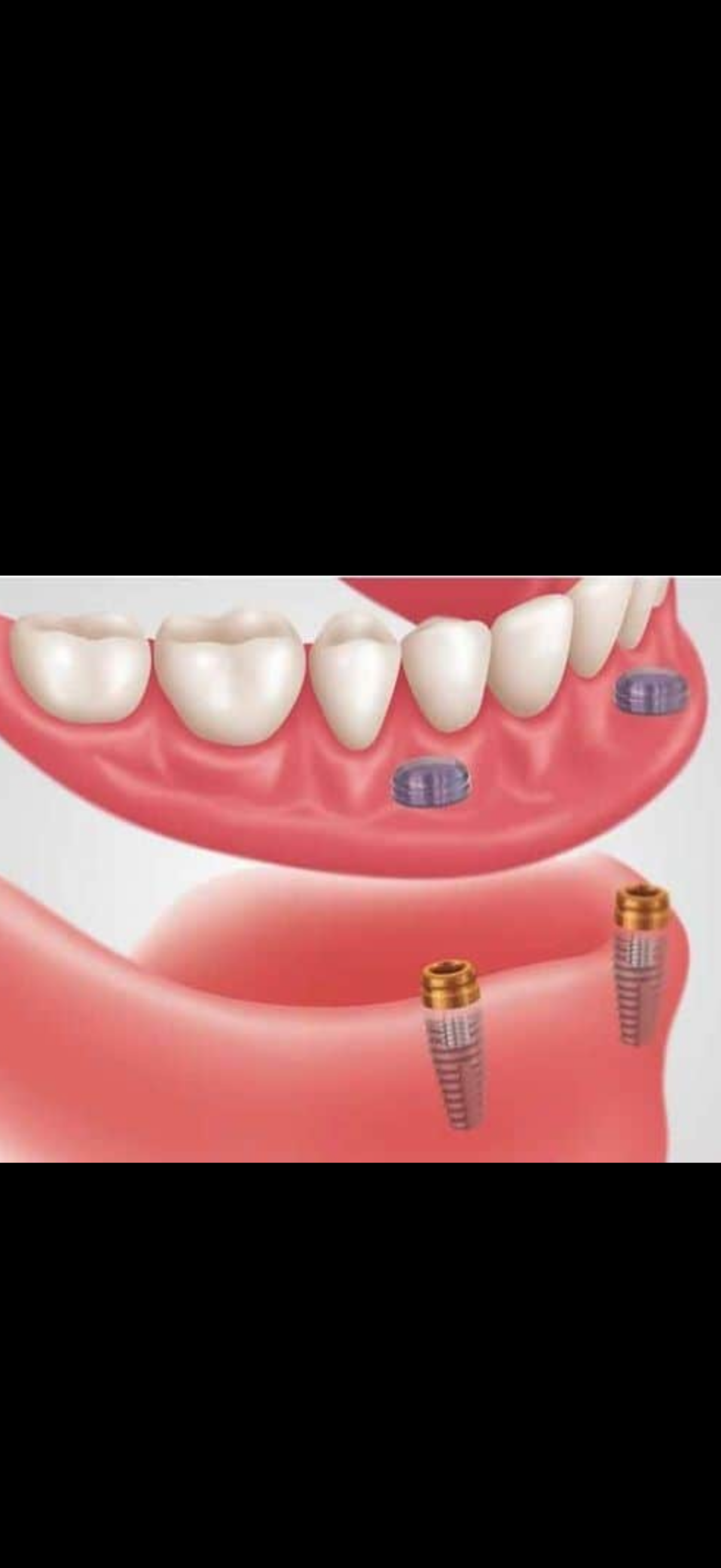 Implant-Supported Dentures